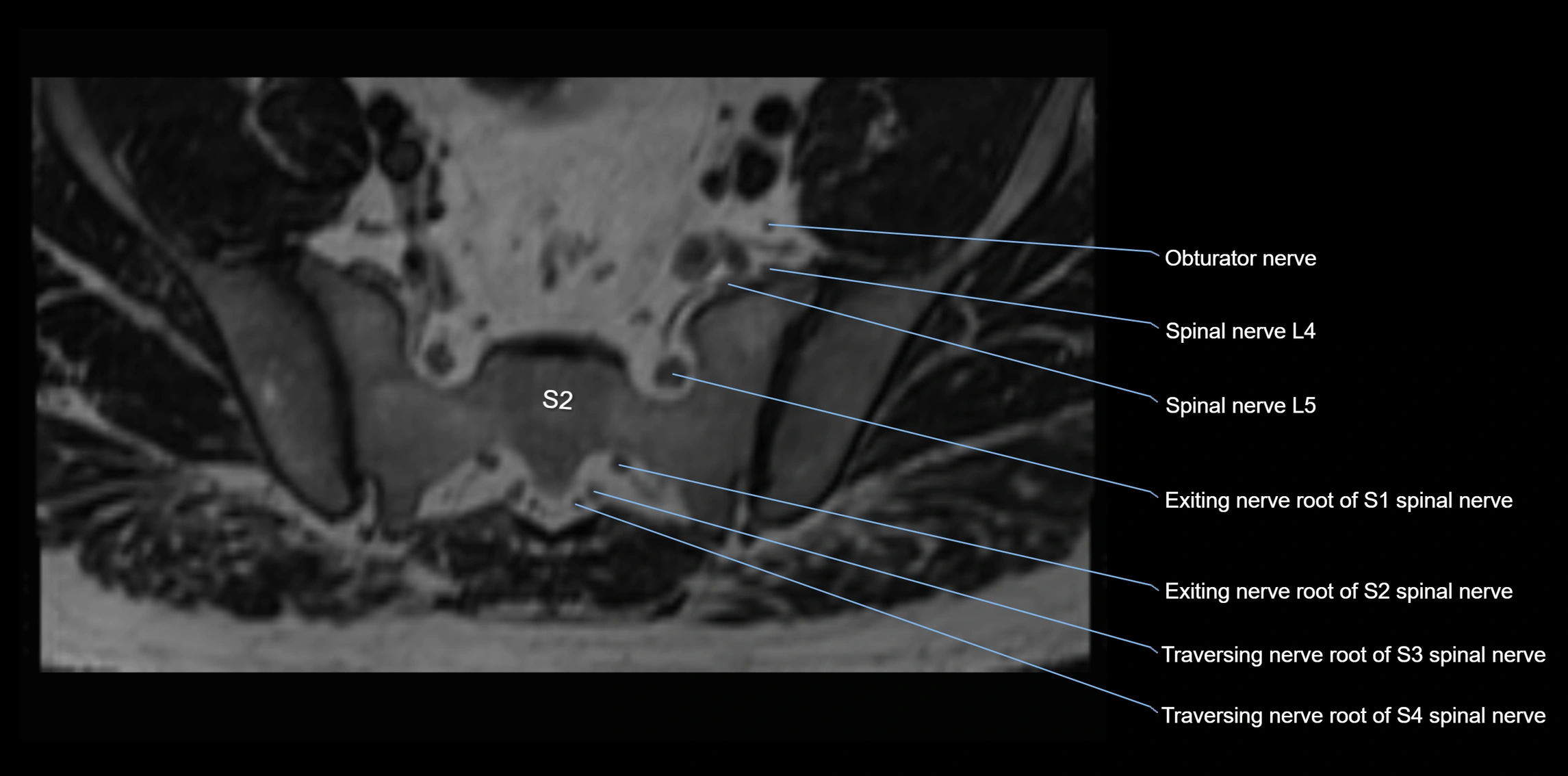 MR lumbosacral plexus axial cross sectional anatomy 3T  radiology  image-img-1008001-00082.webp
